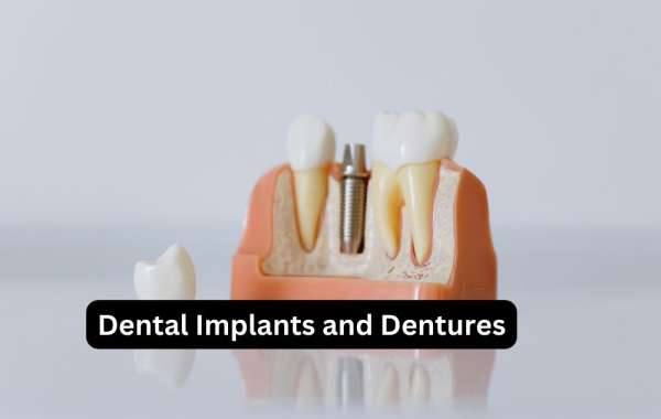 Dental Implants and Dentures: A Comprehensive Guide