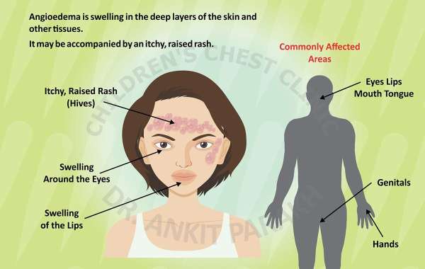 What Are the Best Treatments for Angioedema?