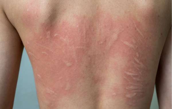 What Are the Best Treatments for Urticaria?