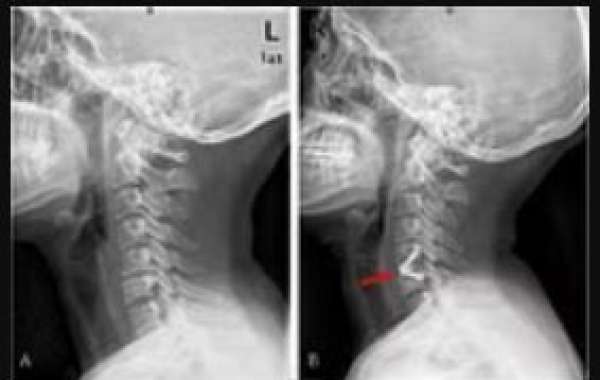 Spinal Stenosis Surgery New York